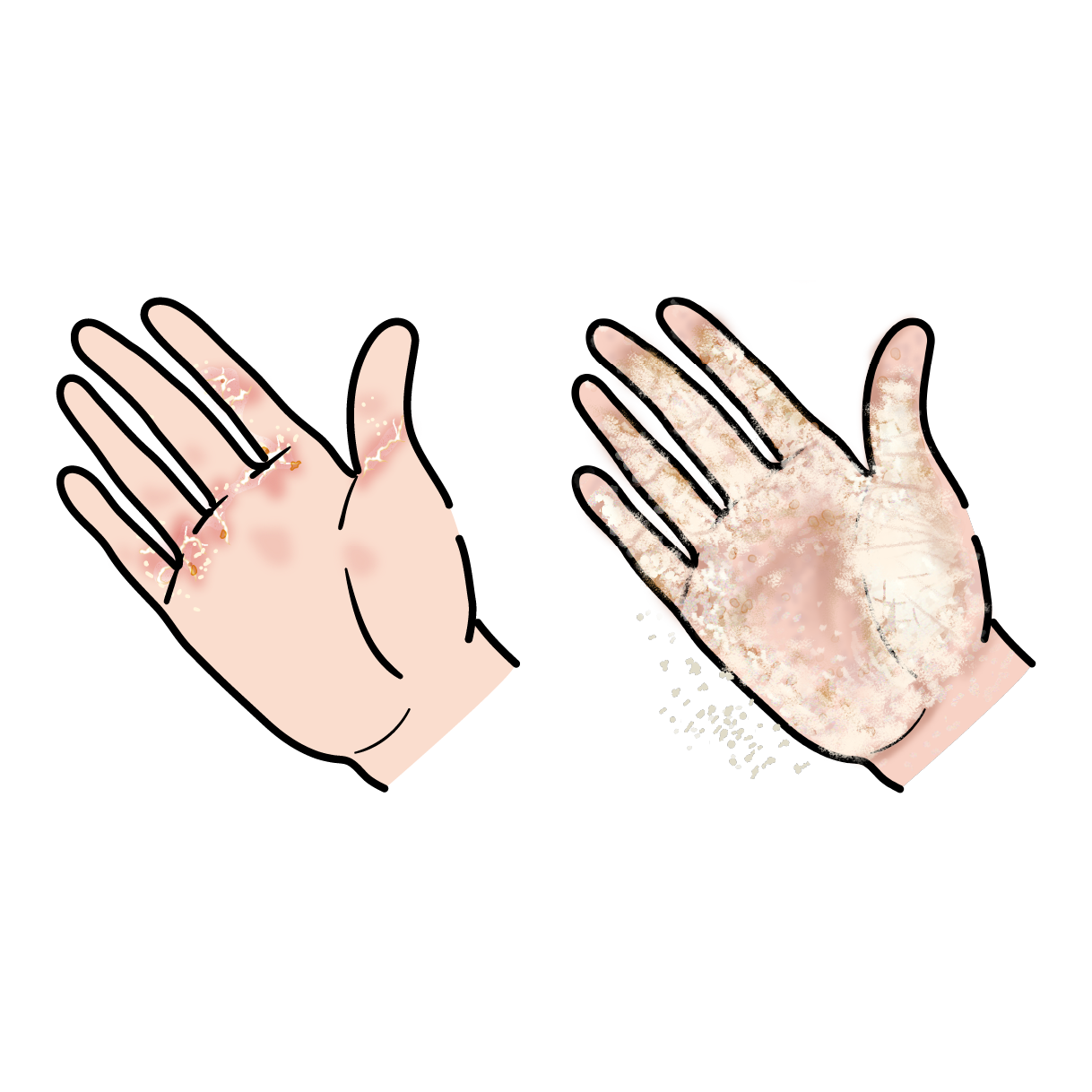 ヒゼンダニのイラスト